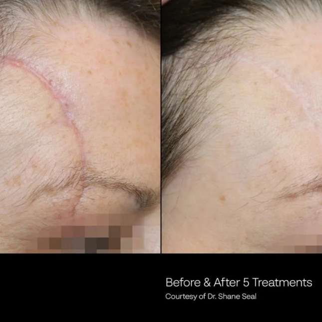 Before and After Photos at Everblooming Cosmetic & Laser Clinic in Pickering, ON