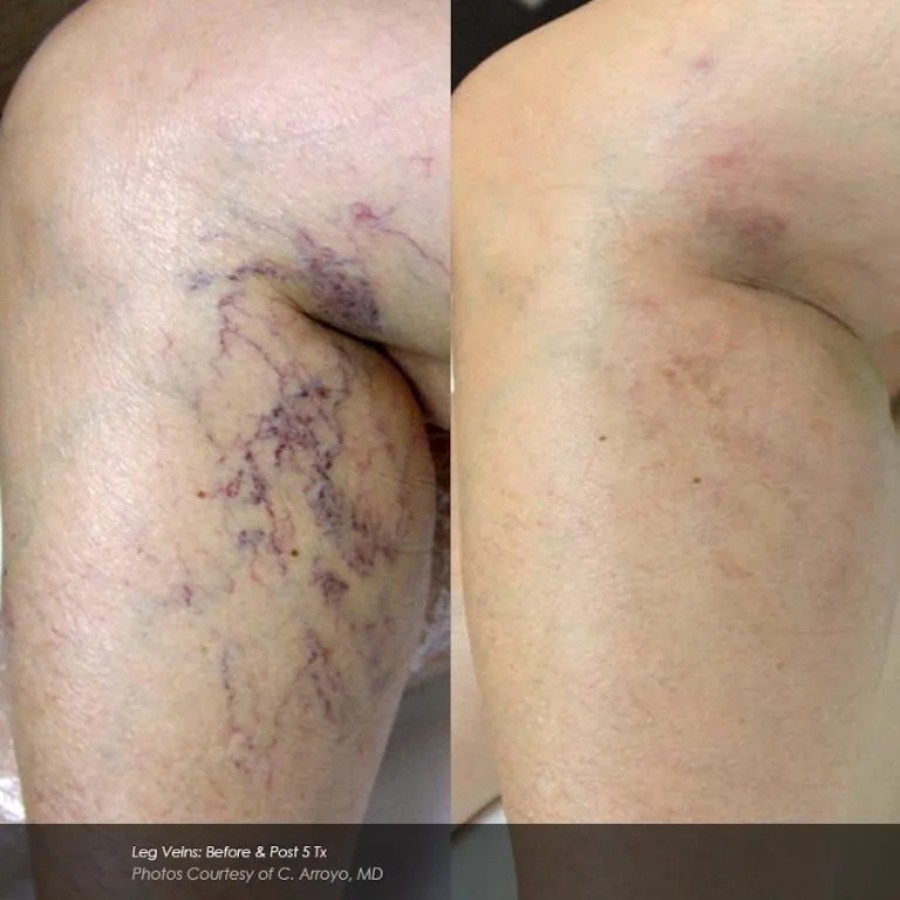 Before and After Photos at Everblooming Cosmetic & Laser Clinic in Pickering, ON