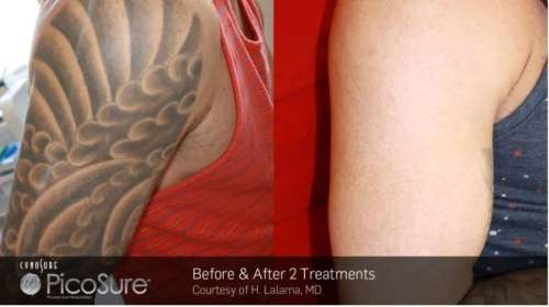 Before and After Photos at Everblooming Cosmetic & Laser Clinic in Pickering, ON