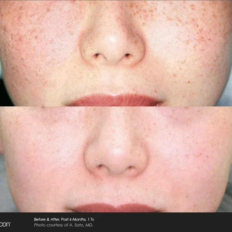Before and After Photos at Everblooming Cosmetic & Laser Clinic in Pickering, ON