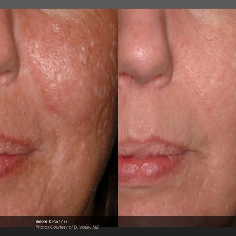 Before and After Photos at Everblooming Cosmetic & Laser Clinic in Pickering, ON