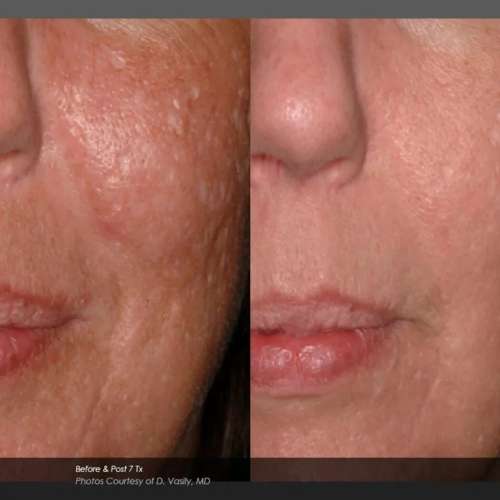 Before and After Photos at Everblooming Cosmetic & Laser Clinic in Pickering, ON