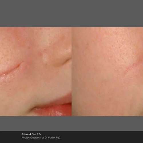 Before and After Photos at Everblooming Cosmetic & Laser Clinic in Pickering, ON