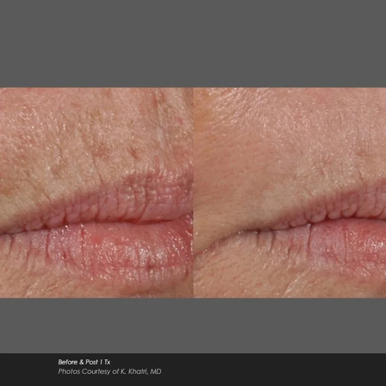 Before and After Photos at Everblooming Cosmetic & Laser Clinic in Pickering, ON