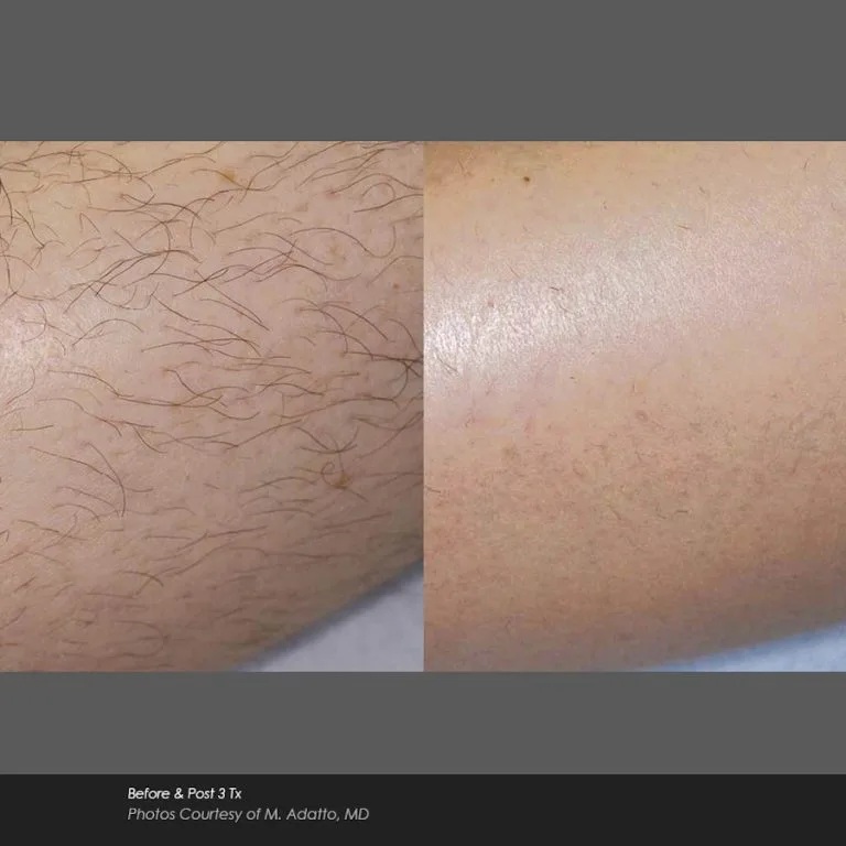 Before and After Photos at Everblooming Cosmetic & Laser Clinic in Pickering, ON