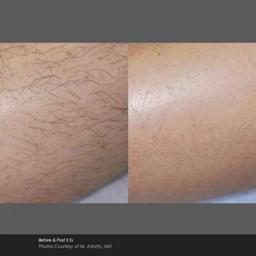 Before and After Photos at Everblooming Cosmetic & Laser Clinic in Pickering, ON