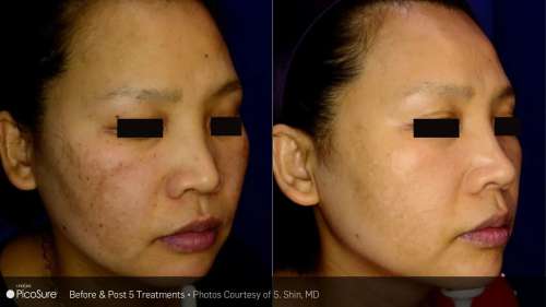 Before and After Photos at Everblooming Cosmetic & Laser Clinic in Pickering, ON