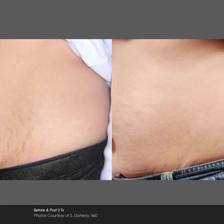 Before and After Photos at Everblooming Cosmetic & Laser Clinic in Pickering, ON