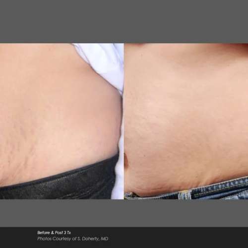 Before and After Photos at Everblooming Cosmetic & Laser Clinic in Pickering, ON