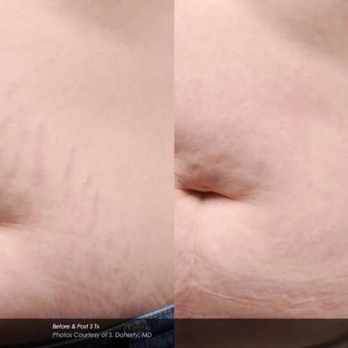 Before and After Photos at Everblooming Cosmetic & Laser Clinic in Pickering, ON