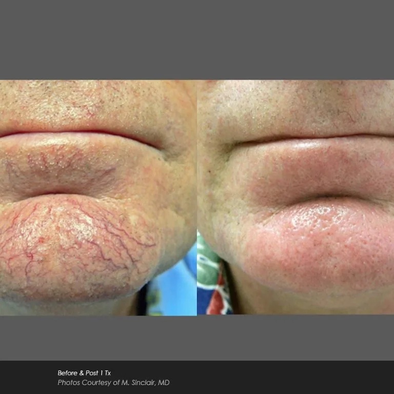 Before and After Photos at Everblooming Cosmetic & Laser Clinic in Pickering, ON