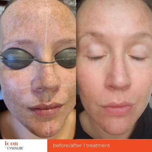 Before and After Photos at Everblooming Cosmetic & Laser Clinic in Pickering, ON