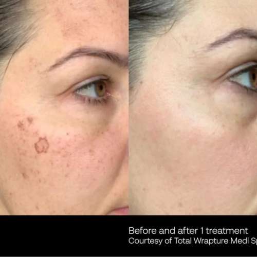 Before and After Photos at Everblooming Cosmetic & Laser Clinic in Pickering, ON