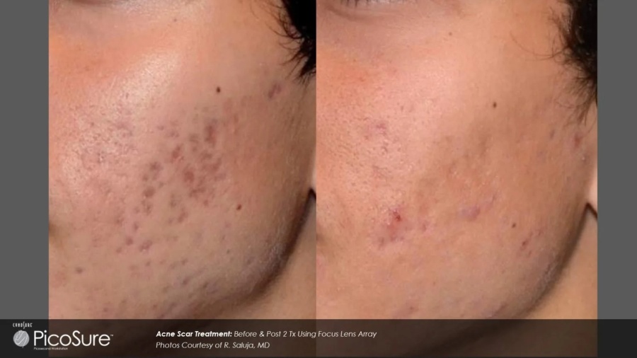 Before and After Photos at Everblooming Cosmetic & Laser Clinic in Pickering, ON