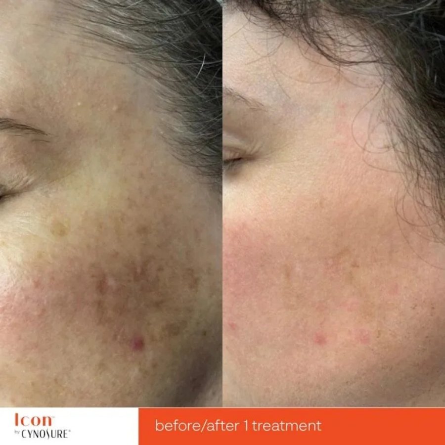 Before and After Photos at Everblooming Cosmetic & Laser Clinic in Pickering, ON