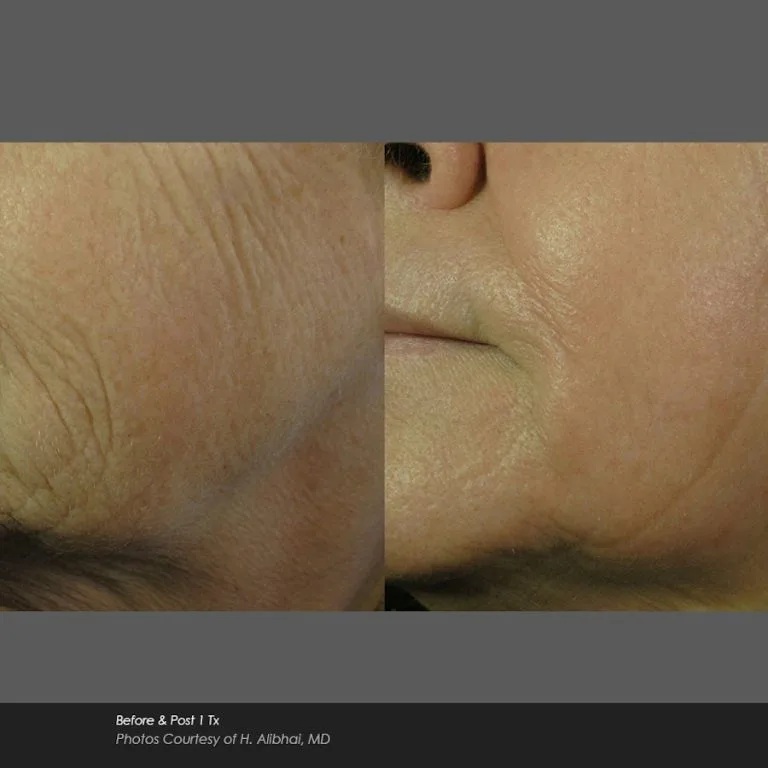 Before and After Photos at Everblooming Cosmetic & Laser Clinic in Pickering, ON