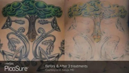 Before and After Photos at Everblooming Cosmetic & Laser Clinic in Pickering, ON