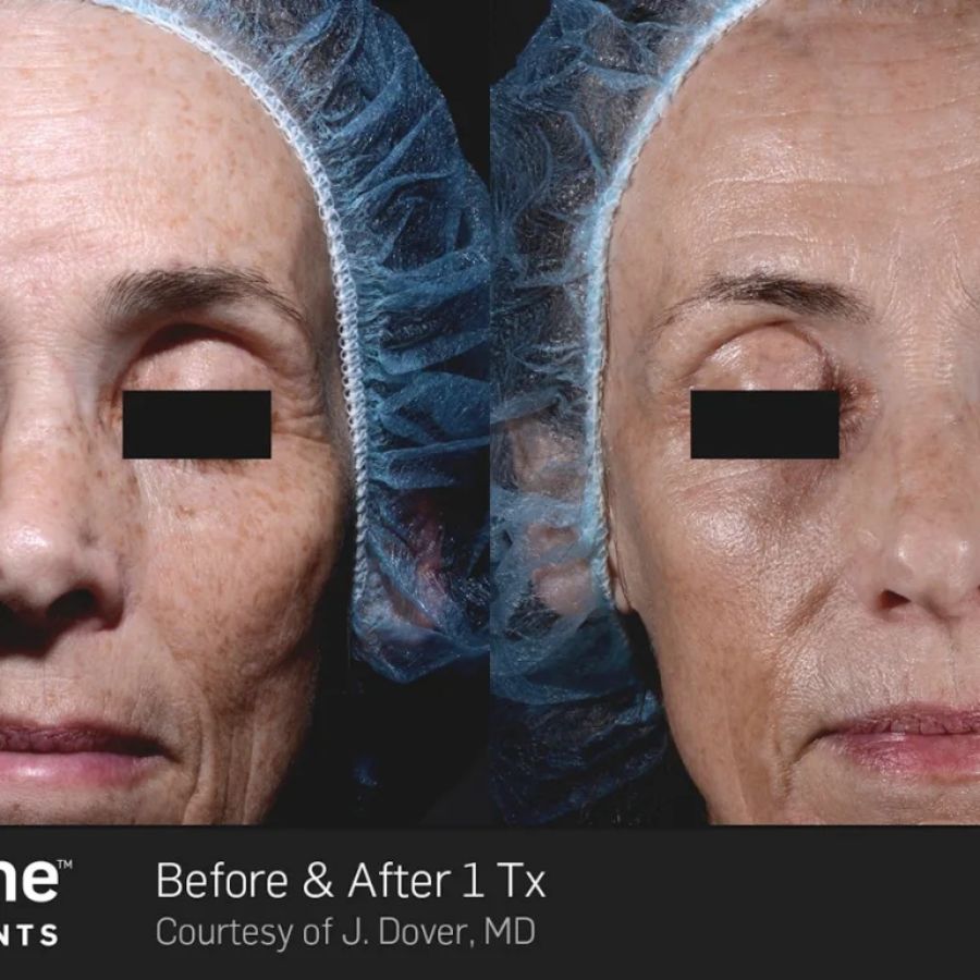 Before and After Photos at Everblooming Cosmetic & Laser Clinic in Pickering, ON