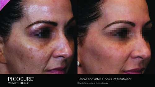 Before and After Photos at Everblooming Cosmetic & Laser Clinic in Pickering, ON