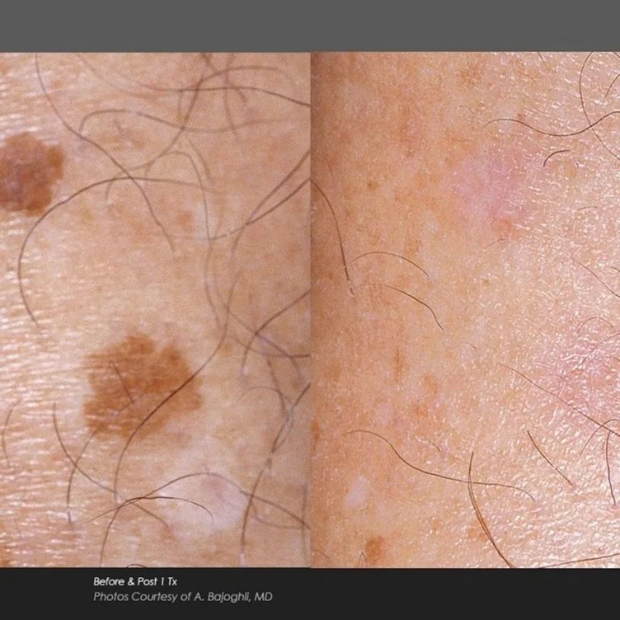 Before and After Photos at Everblooming Cosmetic & Laser Clinic in Pickering, ON