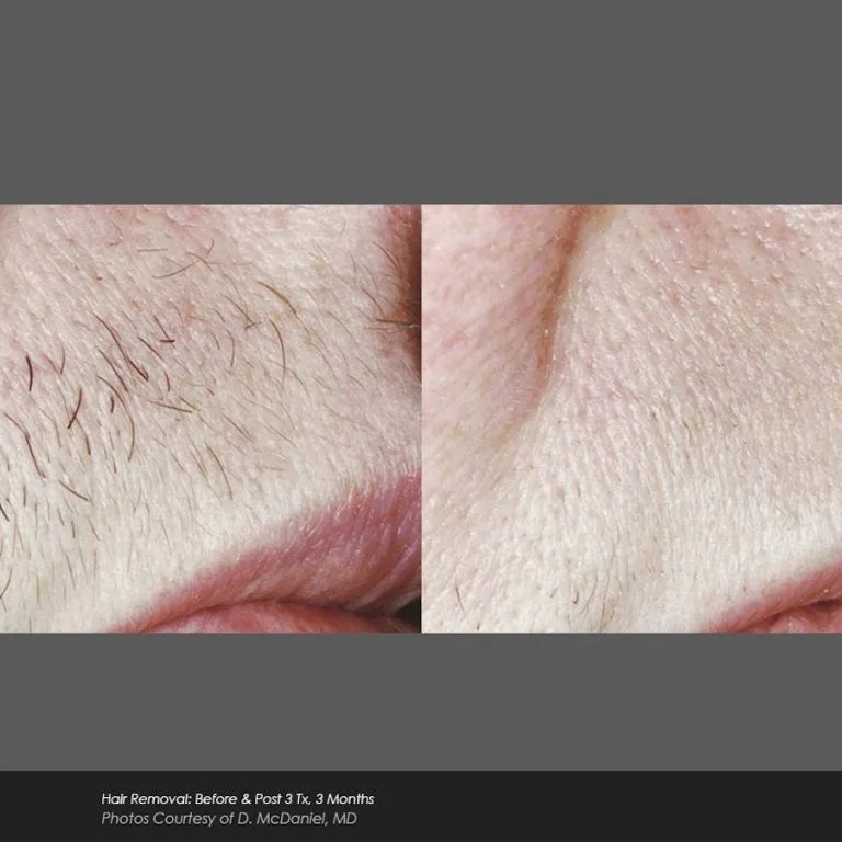 Before and After Photos at Everblooming Cosmetic & Laser Clinic in Pickering, ON