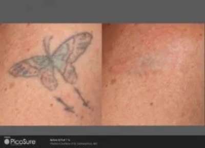 Before and After Photos at Everblooming Cosmetic & Laser Clinic in Pickering, ON