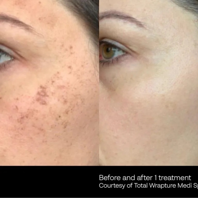Before and After Photos at Everblooming Cosmetic & Laser Clinic in Pickering, ON