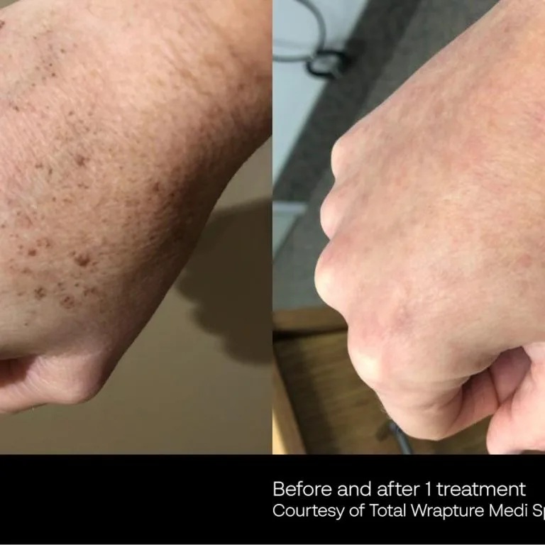 Before and After Photos at Everblooming Cosmetic & Laser Clinic in Pickering, ON