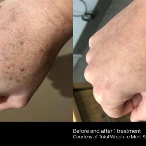 Before and After Photos at Everblooming Cosmetic & Laser Clinic in Pickering, ON