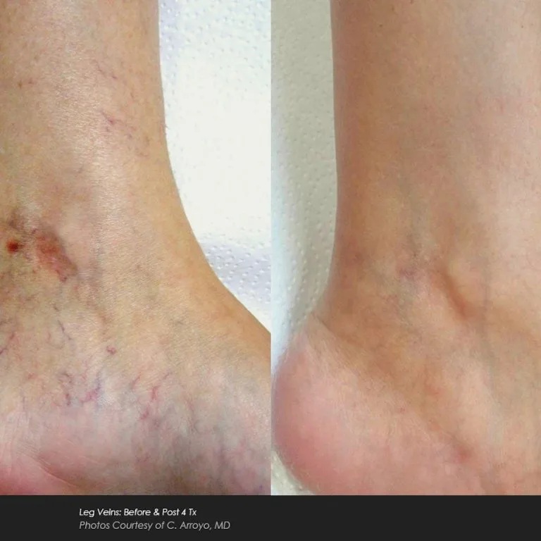 Before and After Photos at Everblooming Cosmetic & Laser Clinic in Pickering, ON