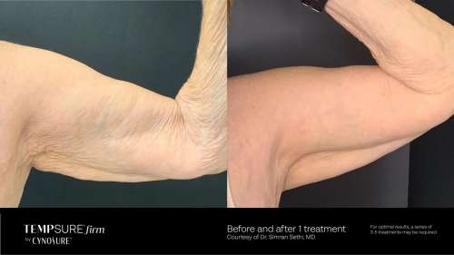Before and After Photos at Everblooming Cosmetic & Laser Clinic in Pickering, ON