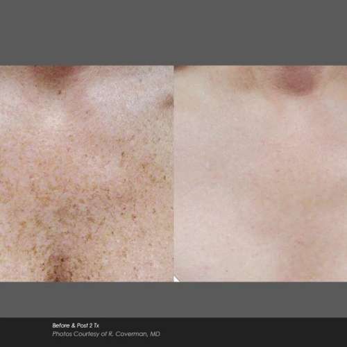 Before and After Photos at Everblooming Cosmetic & Laser Clinic in Pickering, ON