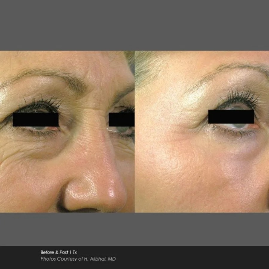 Before and After Photos at Everblooming Cosmetic & Laser Clinic in Pickering, ON