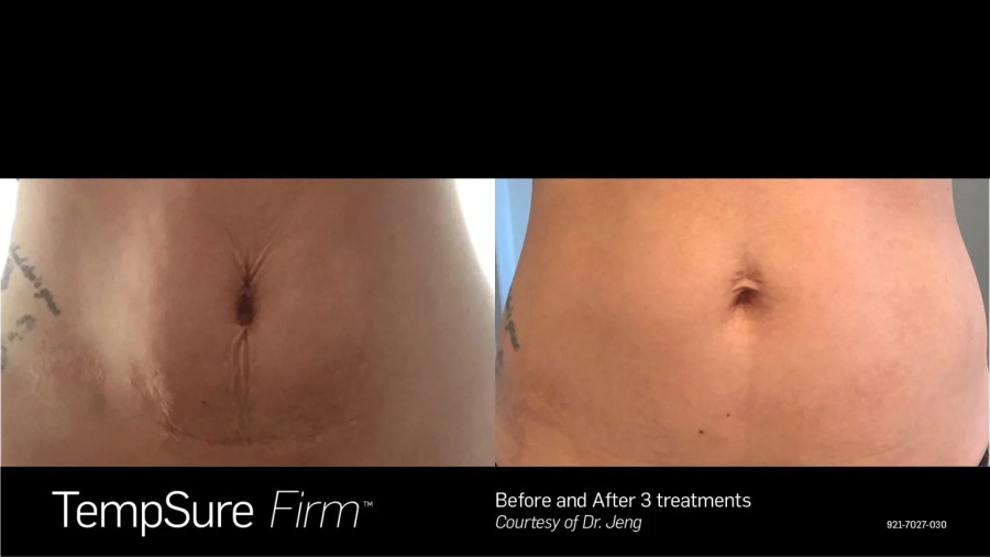 Before and After Photos at Everblooming Cosmetic & Laser Clinic in Pickering, ON