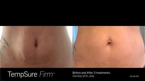 Before and After Photos at Everblooming Cosmetic & Laser Clinic in Pickering, ON