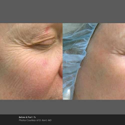 Before and After Photos at Everblooming Cosmetic & Laser Clinic in Pickering, ON