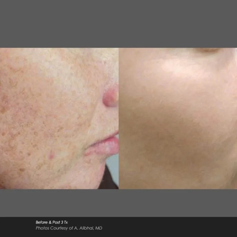 Before and After Photos at Everblooming Cosmetic & Laser Clinic in Pickering, ON