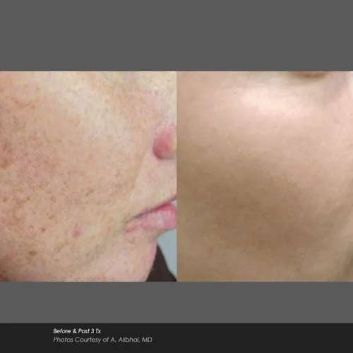 Before and After Photos at Everblooming Cosmetic & Laser Clinic in Pickering, ON