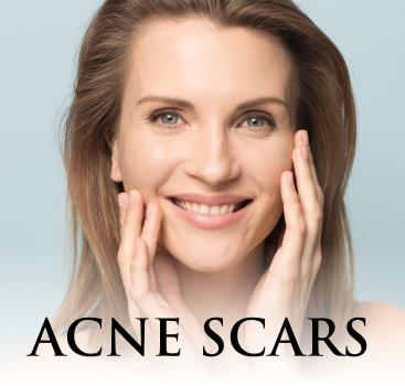 Acne Scars Treatment at Everblooming Cosmetic & Laser Clinic in Pickering, ON