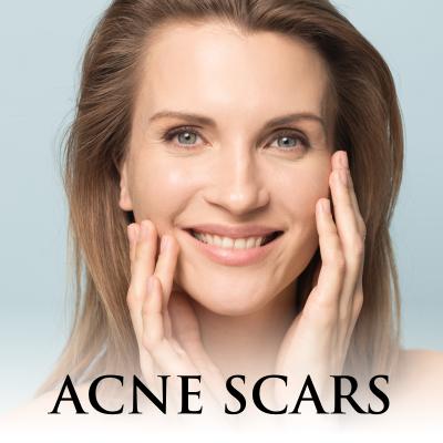 Acne Scars Treatment at Everblooming Cosmetic & Laser Clinic in Pickering, ON