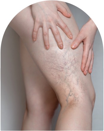 Small Leg Vein Reduction Near Me in Pickering, ON
