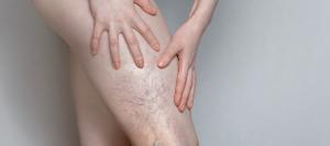 Where Should I Go For Small Leg Vein Reduction in Pickering, ON?