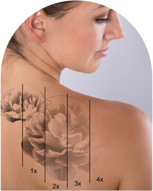 PicoSure Pro Tattoo Removal Near Me in Pickering, ON

