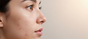 Acne Scar in Pickering, ON