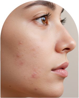 Acne Scar at Everblooming Cosmetic & Laser Clinic in Pickering, ON
