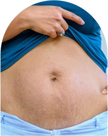 Stretch Marks at Everblooming Cosmetic & Laser Clinic in Pickering, ON
