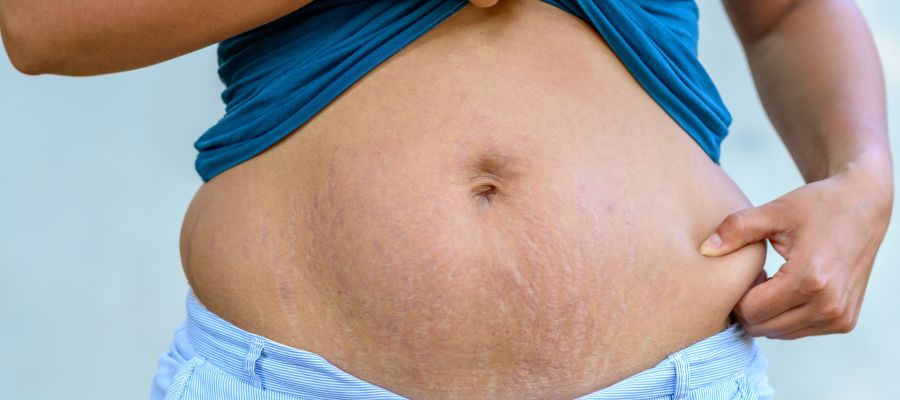 Stretch Marks Reduction Specialist in Pickering, ON