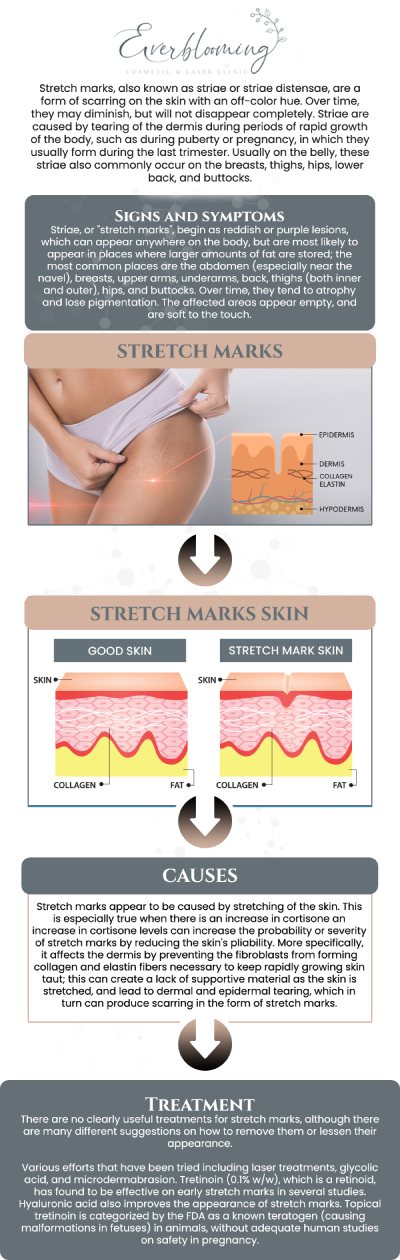 While stretch marks are a natural part of life, Dr. Gihan El Mokadem and her professional team offer innovative solutions to significantly improve their texture and color. Using a combination of microneedling and laser resurfacing, we stimulate deep collagen production to knit the skin back together and diminish the appearance of striae. For more information, contact us today or schedule an appointment online. We are conveniently located at 1885 Glenanna Rd Unit # 110, Pickering, ON L1V 6R6.